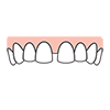 بستن فضای بین دندان